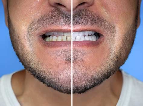 teeth extraction