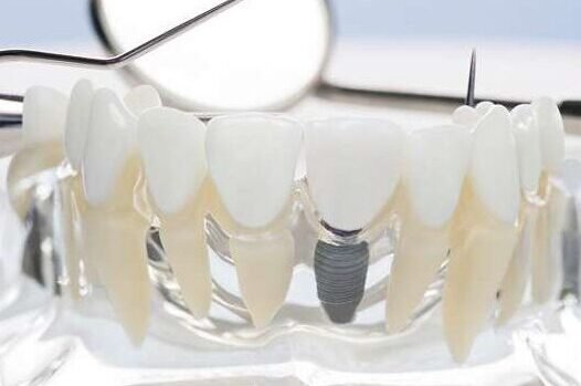 replace missing teeth