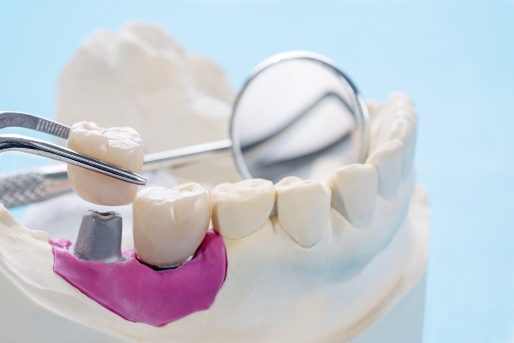 badly decayed teeth
