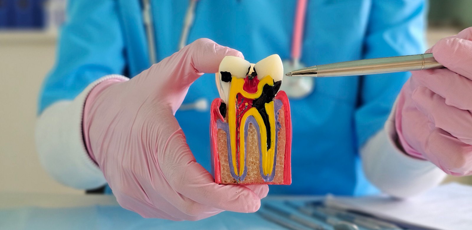 Laser Root Canal in Shapur