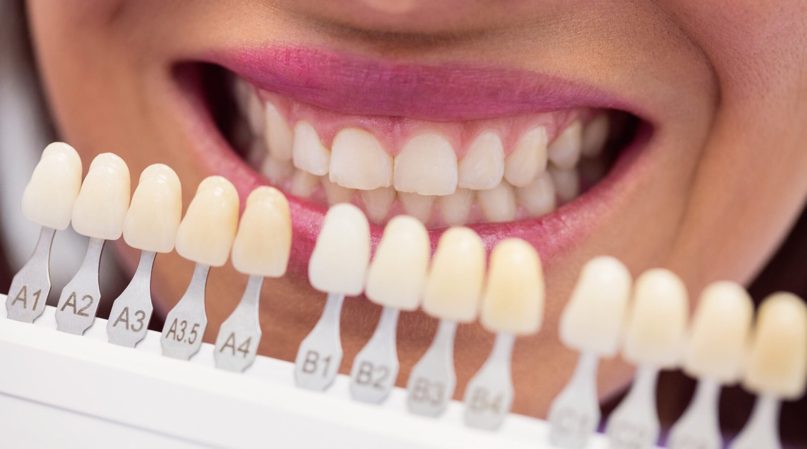 dental veneers in shapur