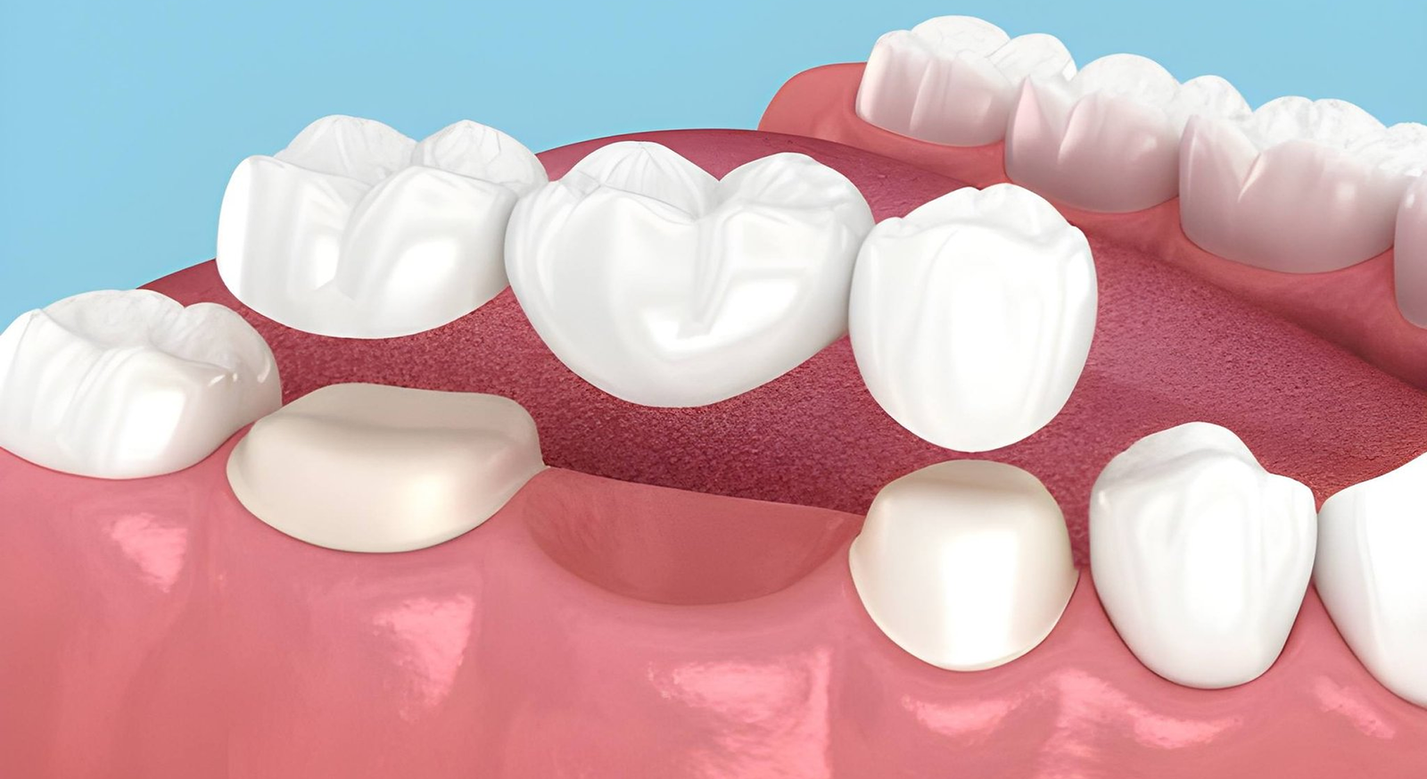 Dental bridges in Shapur