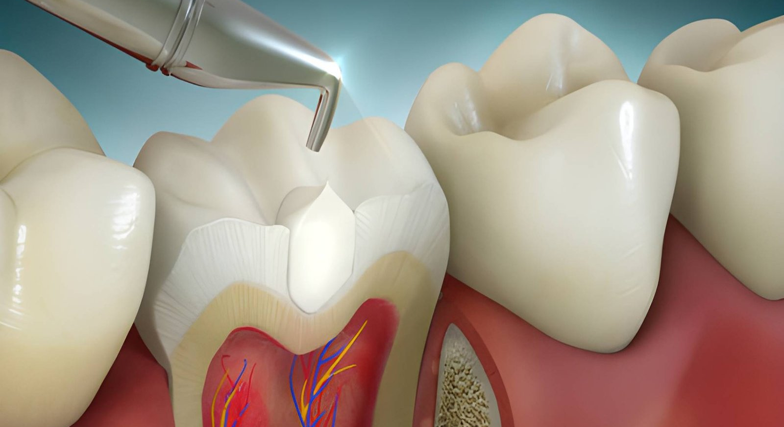 Composite Fillings in Shapur