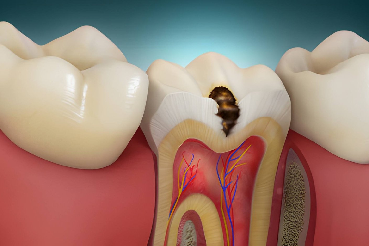 Composite Fillings in Shapur