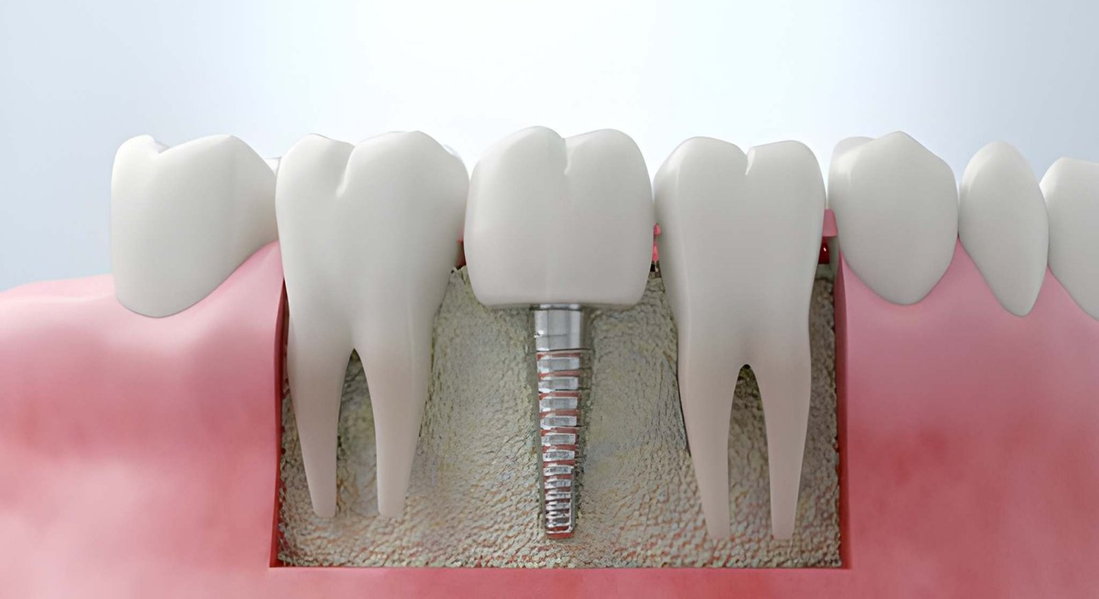 Dental Implants in shapur