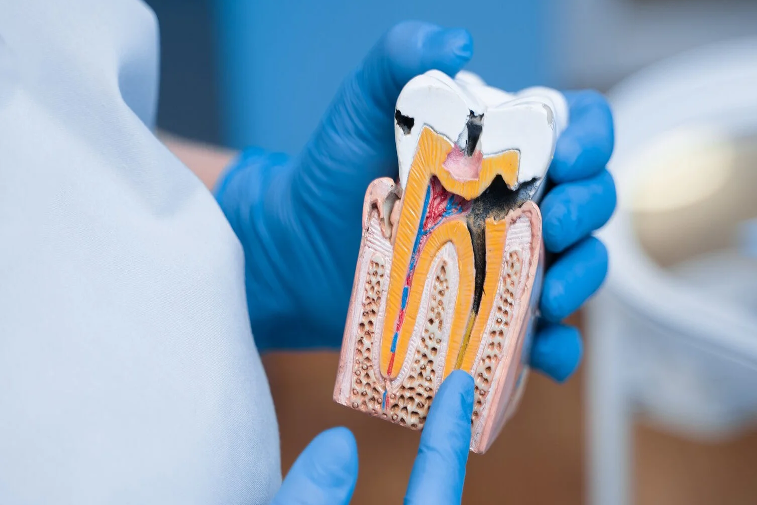 Laser Root Canal in Shapur